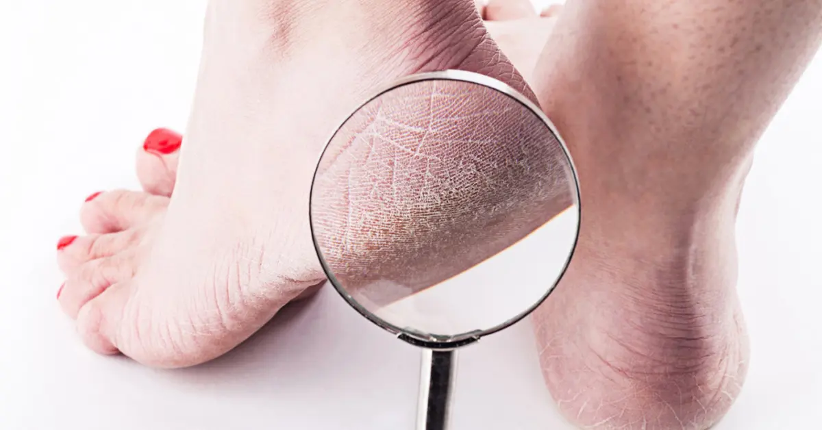 Adieu peau morte : 5 méthodes efficaces pour des pieds doux